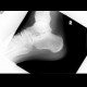 Undisplaced fracture of calcaneus: X-ray - Plain radiograph